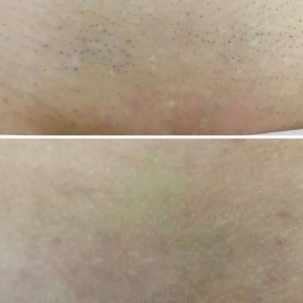 bikini laser hair removal melbourne