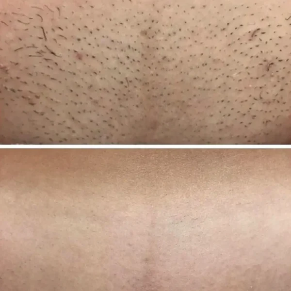 bikini line hair removal