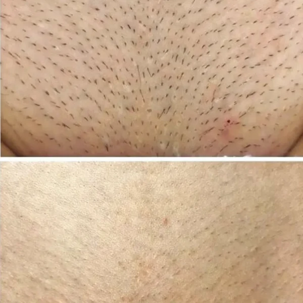 bikini line laser