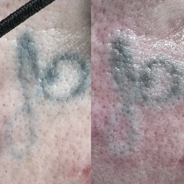 colour laser tattoo removal