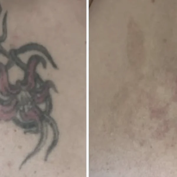 colour laser tattoo removal melbourne