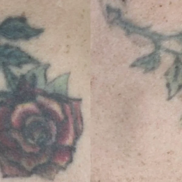 colour laser tattoo removal near me