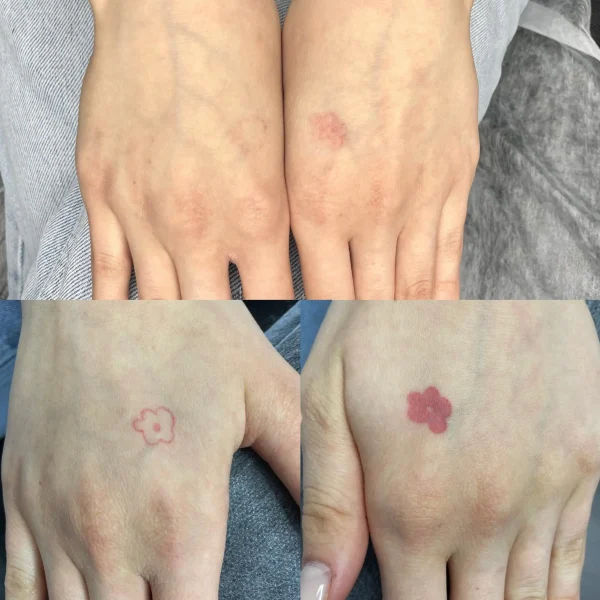 colour tattoo removal cost