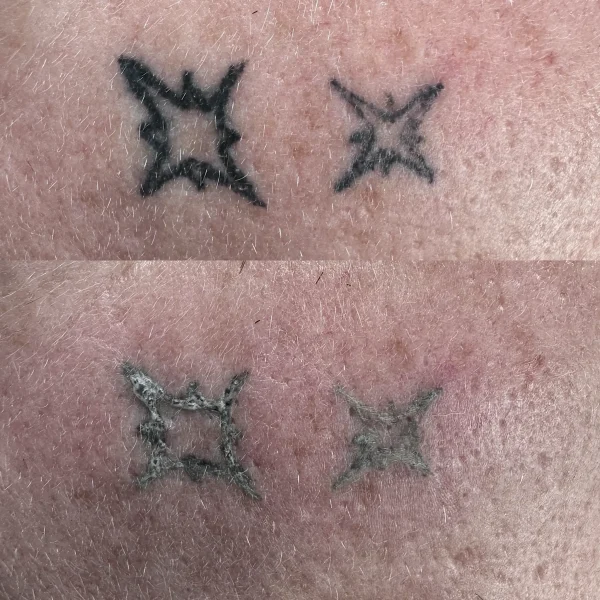 colour tattoo removal melbourne