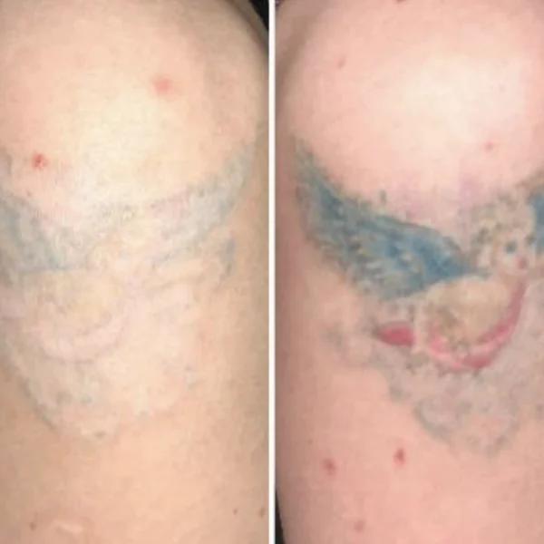colour tattoo removal near me
