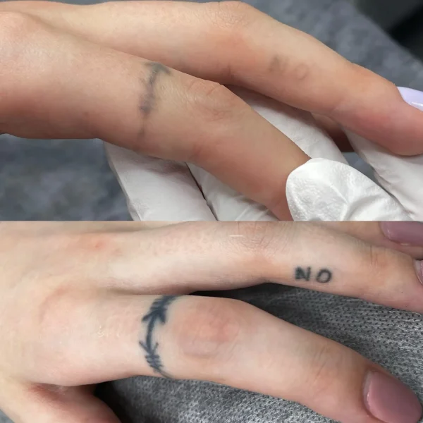 colour tattoo removal price