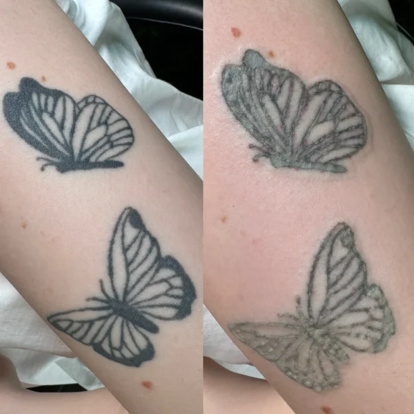 colour tattoo removal