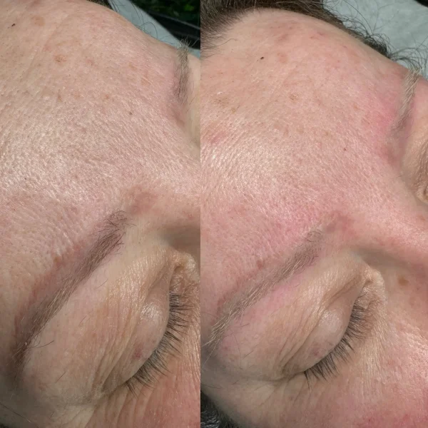 cosmetic tattoo removal cost