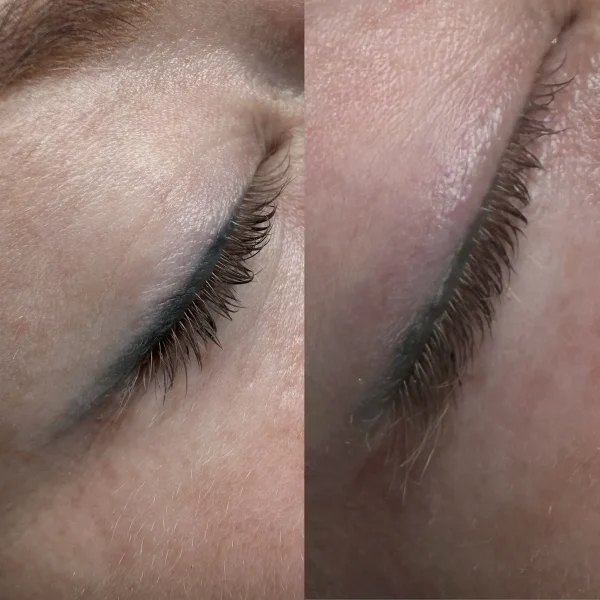 cosmetic tattoo removal near me