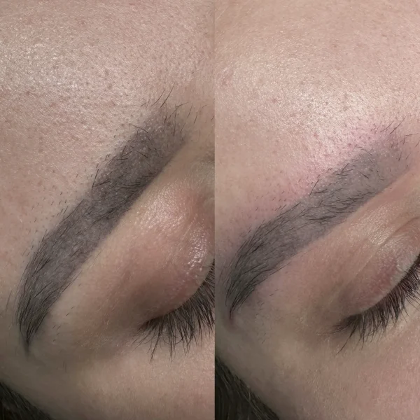 cosmetic tattoo removal price melbourne