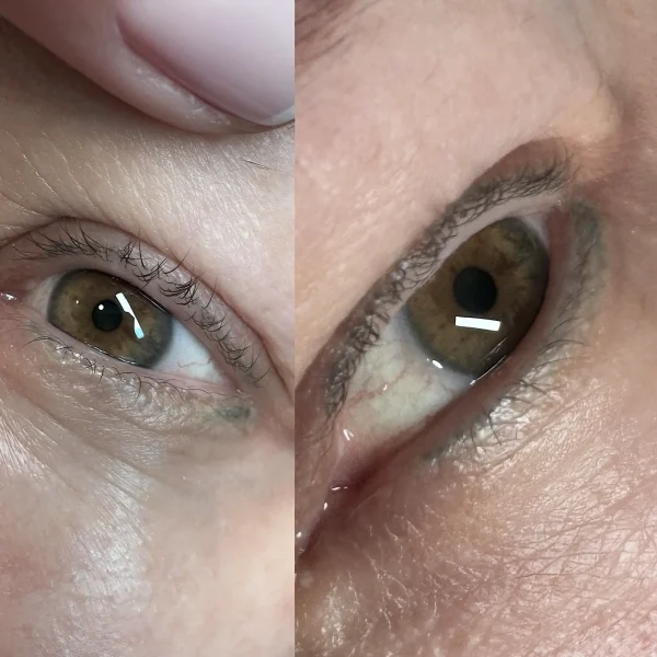 cosmetic tattoo removal price