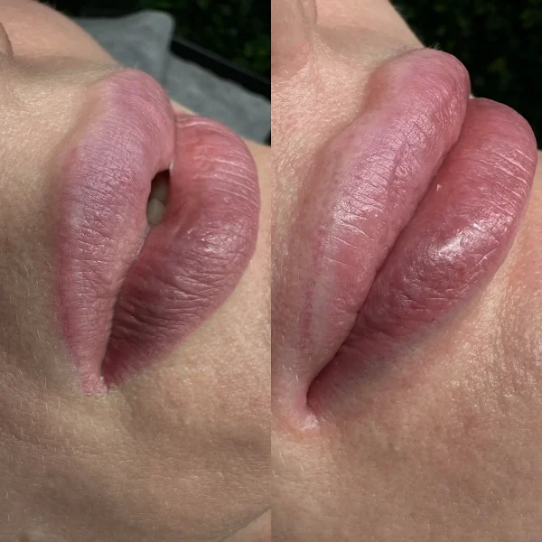 cosmetic tattoo removal
