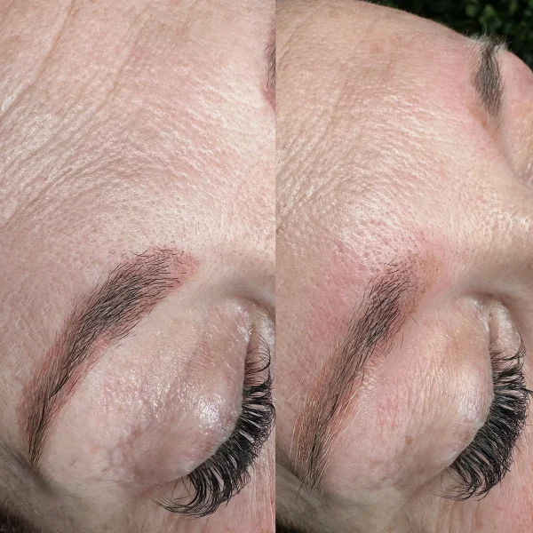 cosmetic tattoo removal treatment