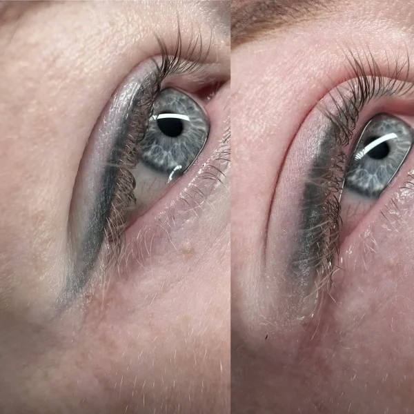 cosmetic tattooing removal melbourne