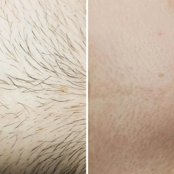 laser-hair-clinic-cost