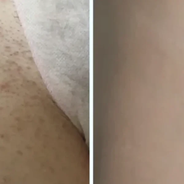 laser-hair-clinic-price