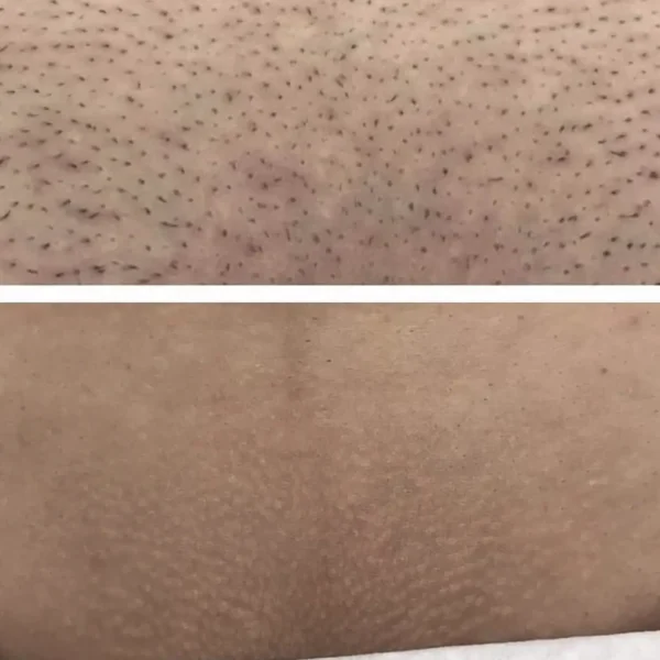 laser hair removal bikini area