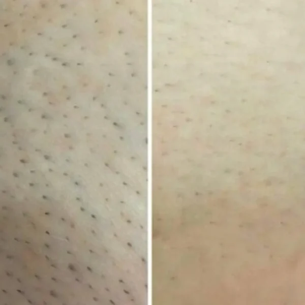 laser hair removal bikini melbourne