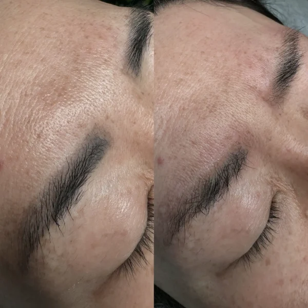 melbourne cosmetic tattoo removal
