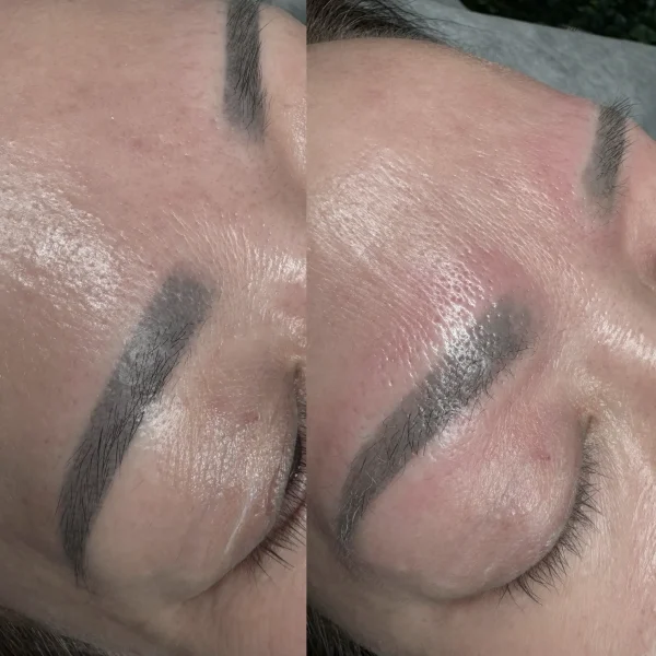 permanent makeup removal laser