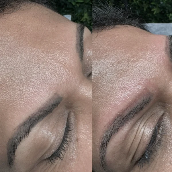 permanent makeup removal