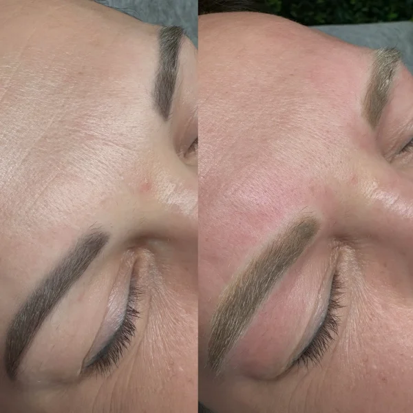 removal cosmetic tattoo melbourne
