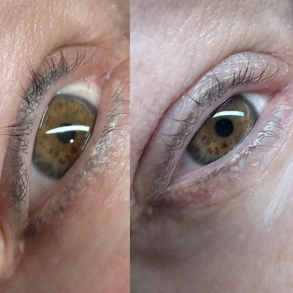 removal cosmetic tattoo near me