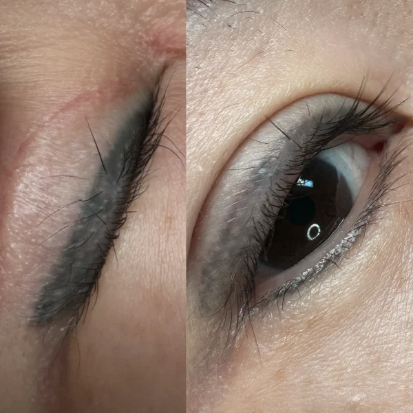 removal cosmetic tattoo