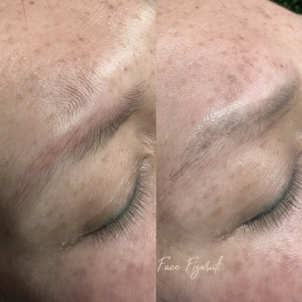 semi permanent makeup removal near me